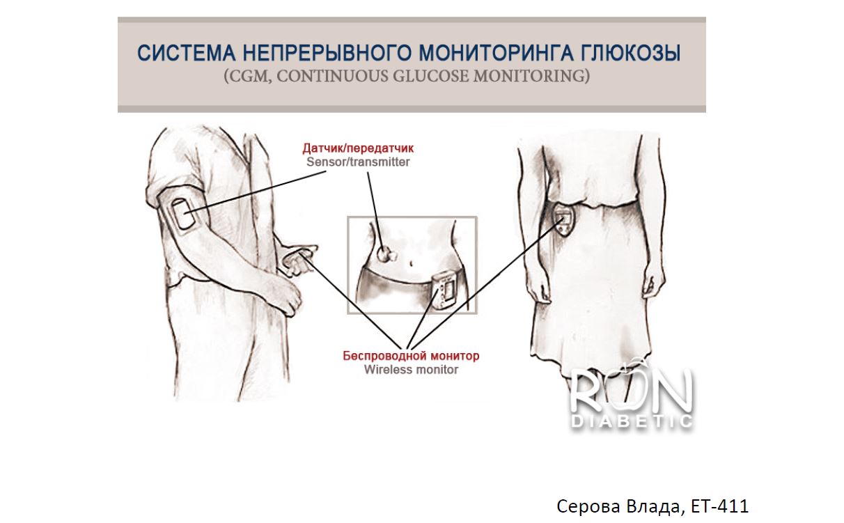 Система непрерывного мониторинга глюкозы. Системе непрерывного мониторирования уровня Глюкозы. Непрерывный мониторинг Глюкозы. Система непрерывного мониторинга сахара. Непрерывный мониторинг Глюкозы в крови.